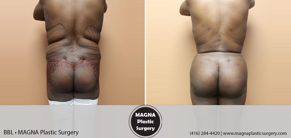 bbl-magna-plastic-surgery-dr-mansour-bendago_0101