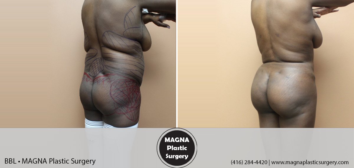 bbl-magna-plastic-surgery-dr-mansour-bendago_0102
