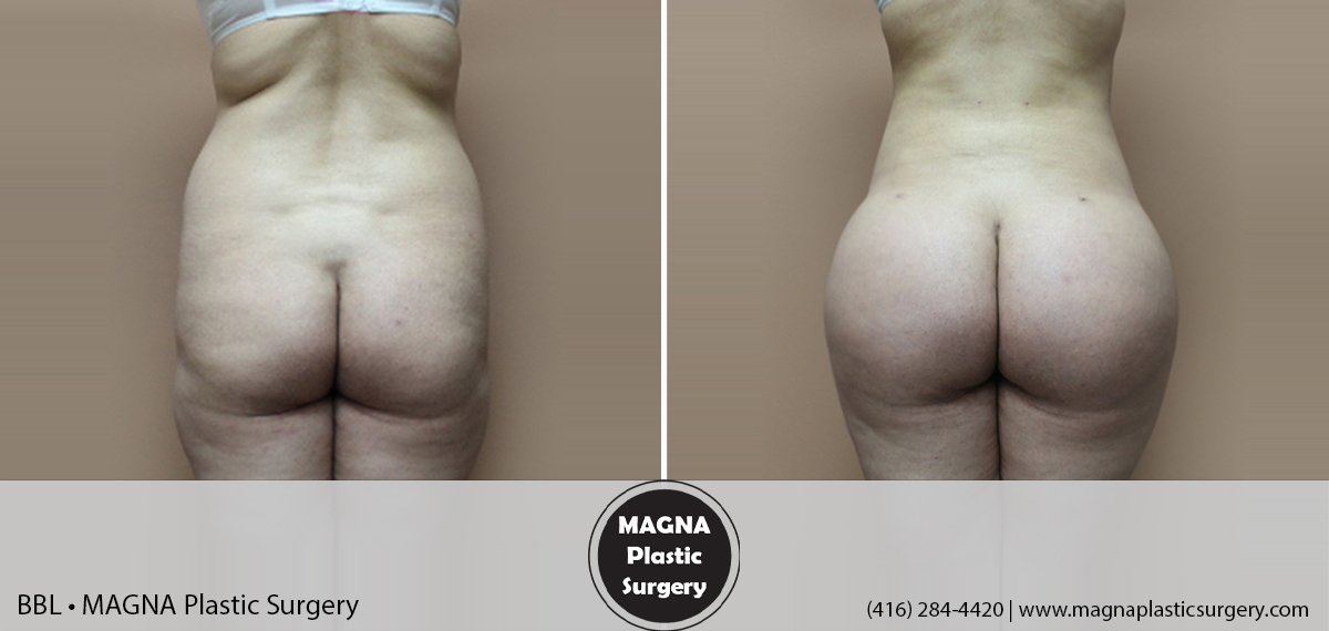 bbl-magna-plastic-surgery-dr-mansour-bendago_0201