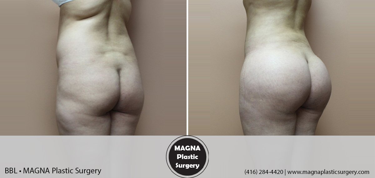 bbl-magna-plastic-surgery-dr-mansour-bendago_0202