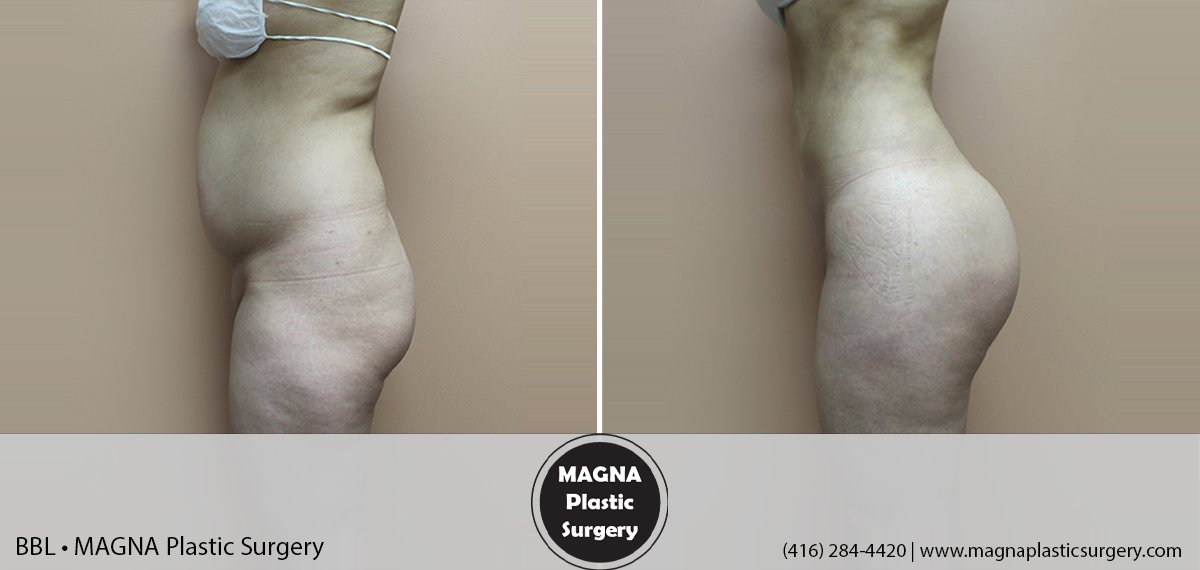 bbl-magna-plastic-surgery-dr-mansour-bendago_0203