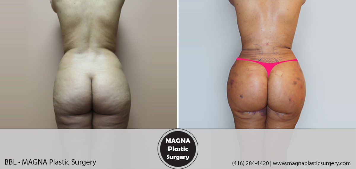 bbl-magna-plastic-surgery-dr-mansour-bendago_0301