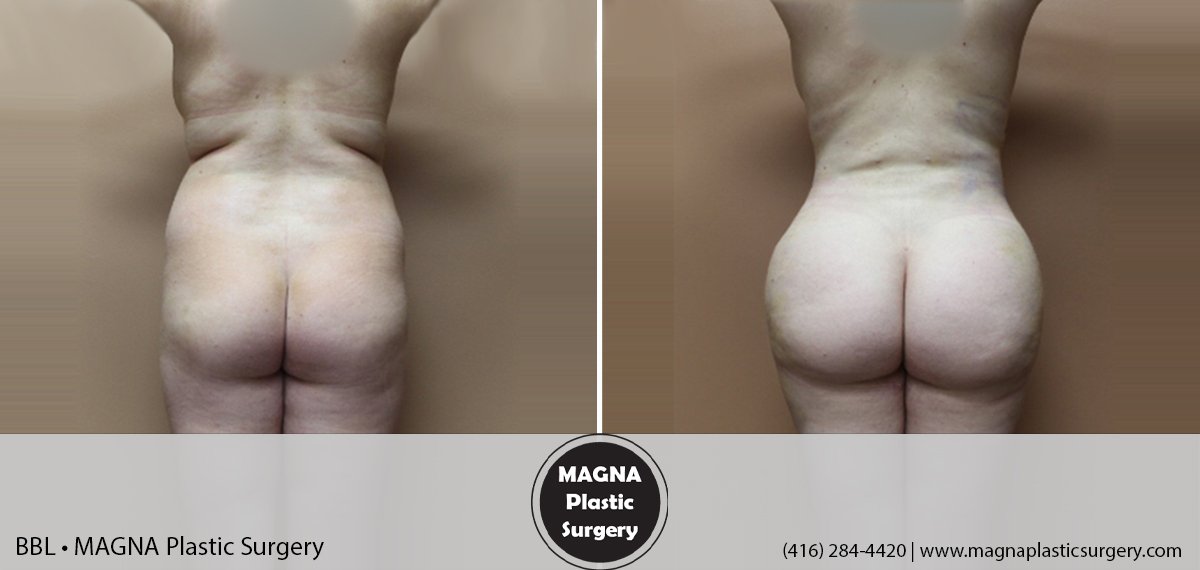 bbl-magna-plastic-surgery-dr-mansour-bendago_0401