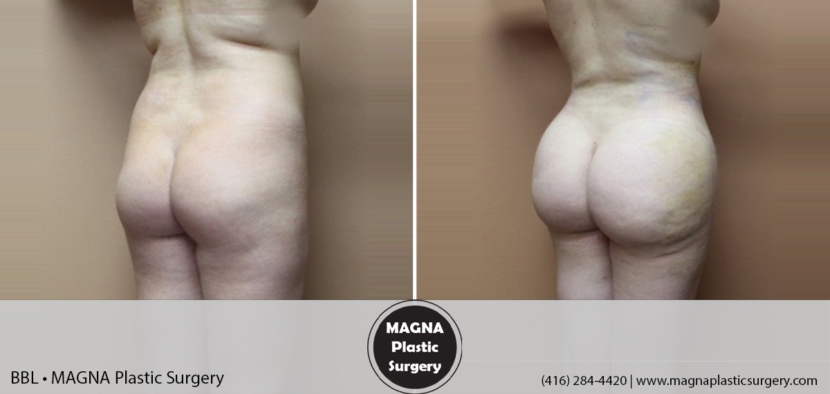 bbl-magna-plastic-surgery-dr-mansour-bendago_0402