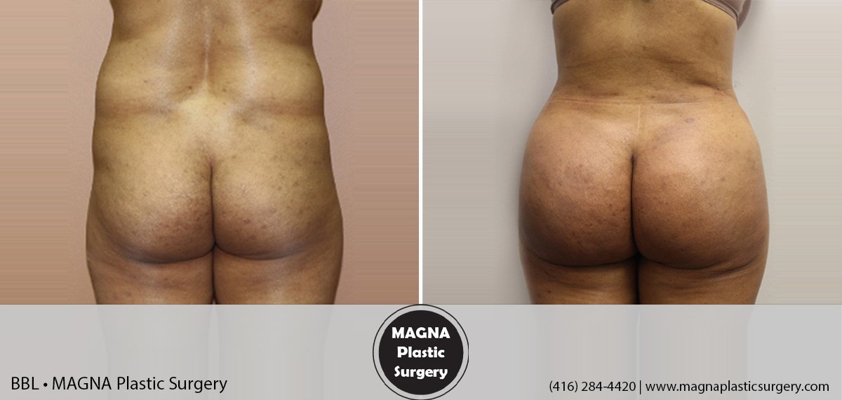 bbl-magna-plastic-surgery-dr-mansour-bendago_0501