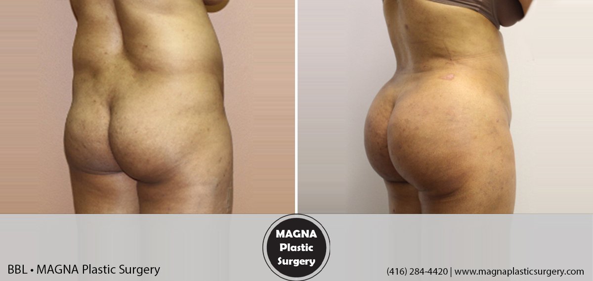 bbl-magna-plastic-surgery-dr-mansour-bendago_0502