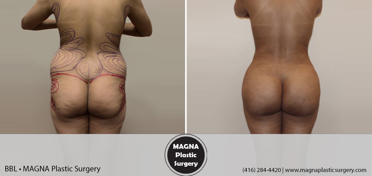 bbl-magna-plastic-surgery-dr-mansour-bendago_0601