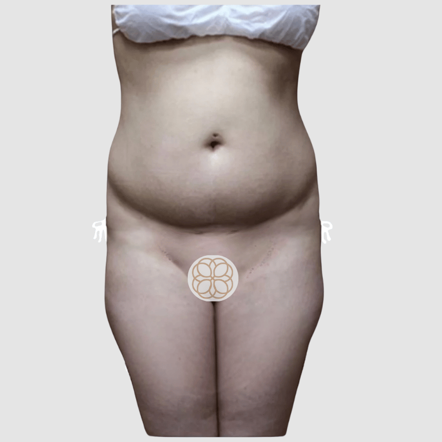 BBL + Liposuction before