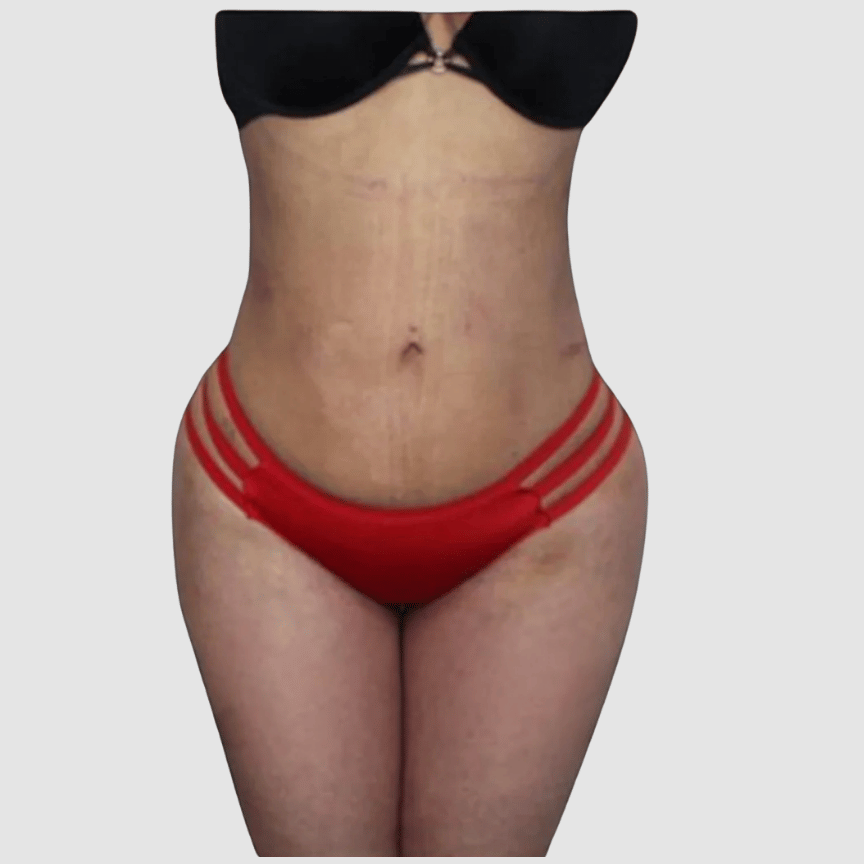 BBL + Liposuction after