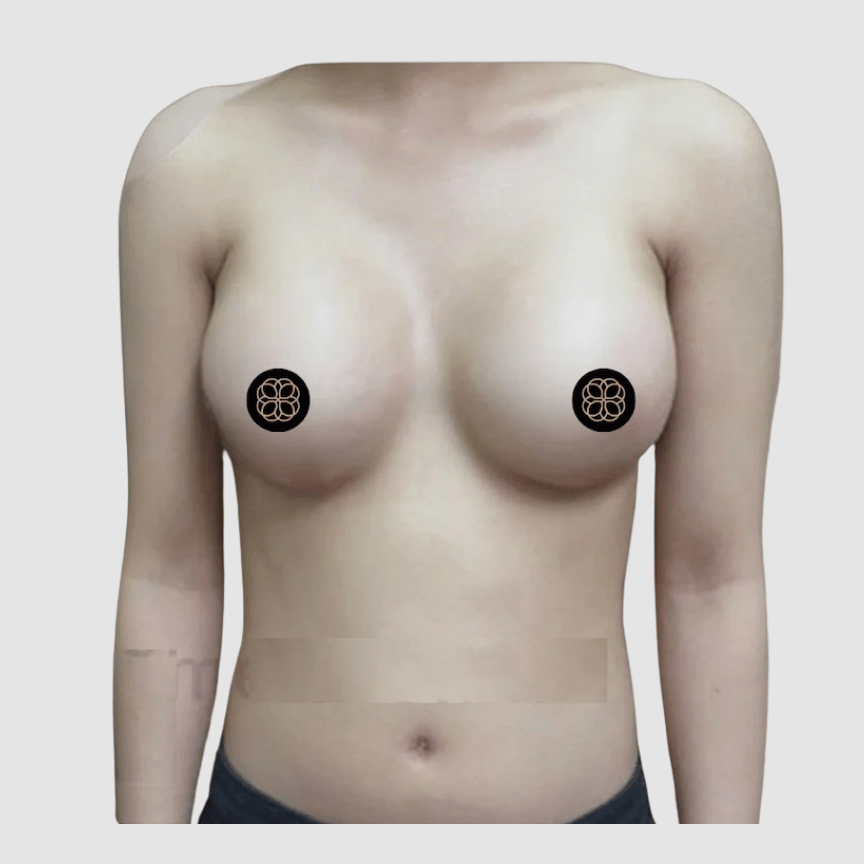 Breast Augmentation after