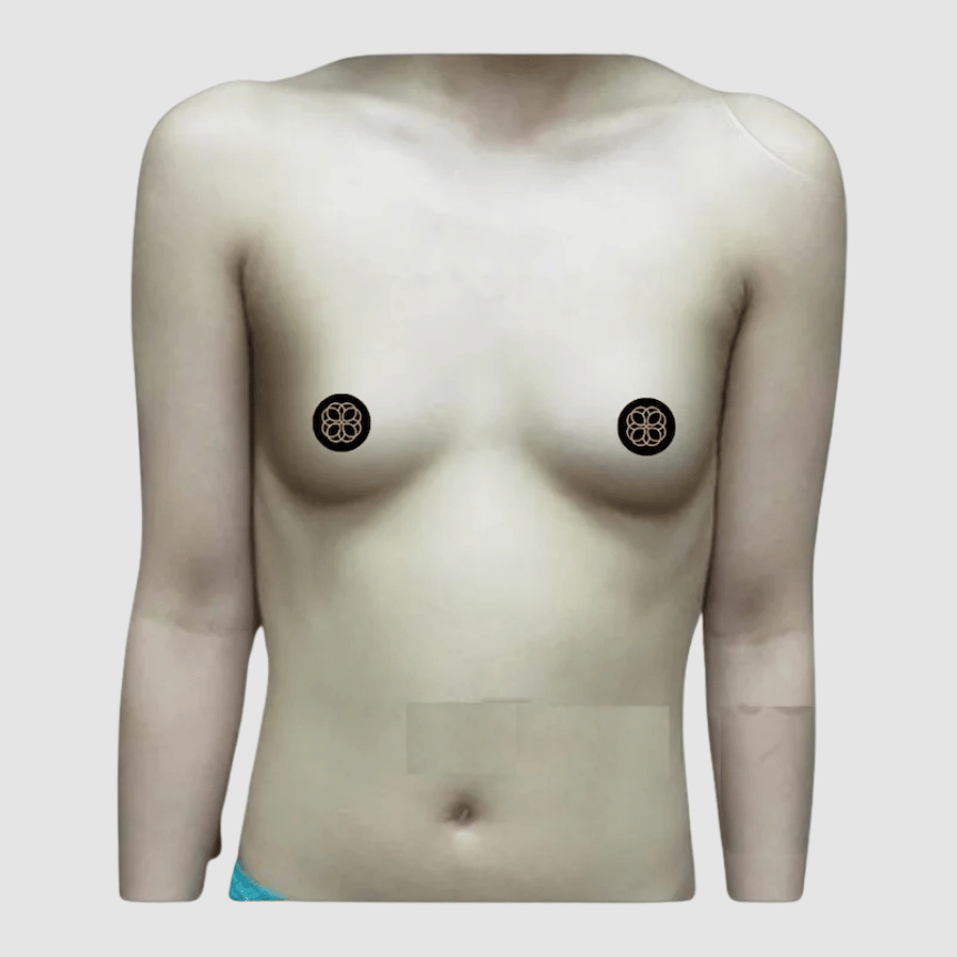 Breast Augmentation before