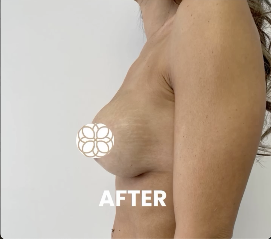 Breast Augmentation with Breast Implant and Breast Lift after