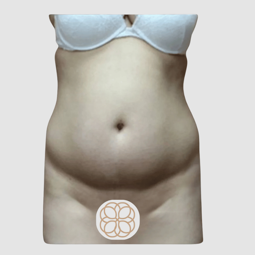 This liposuction was performed on a female age 32. She wanted an hourglass figure and came in with the end goal on a reduced waist and hips. before