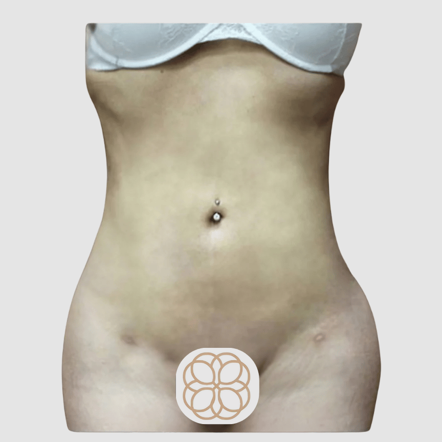 This liposuction was performed on a female age 32. She wanted an hourglass figure and came in with the end goal on a reduced waist and hips. after
