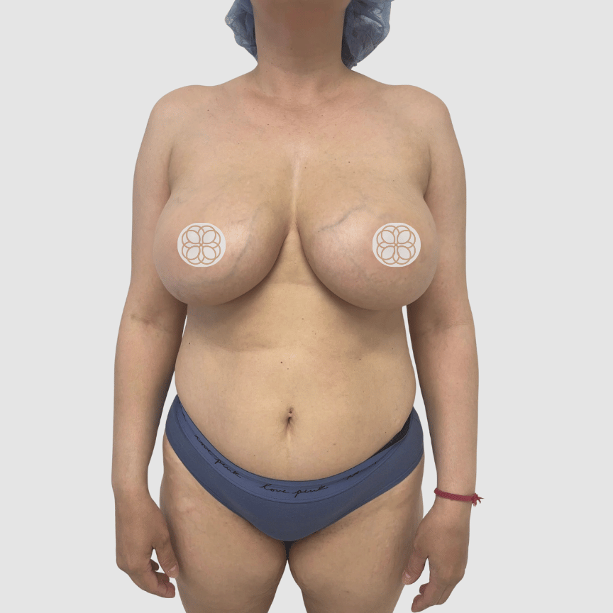 Breast Reduction and Breast Lift before