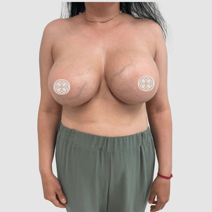 Breast Reduction and Breast Lift after