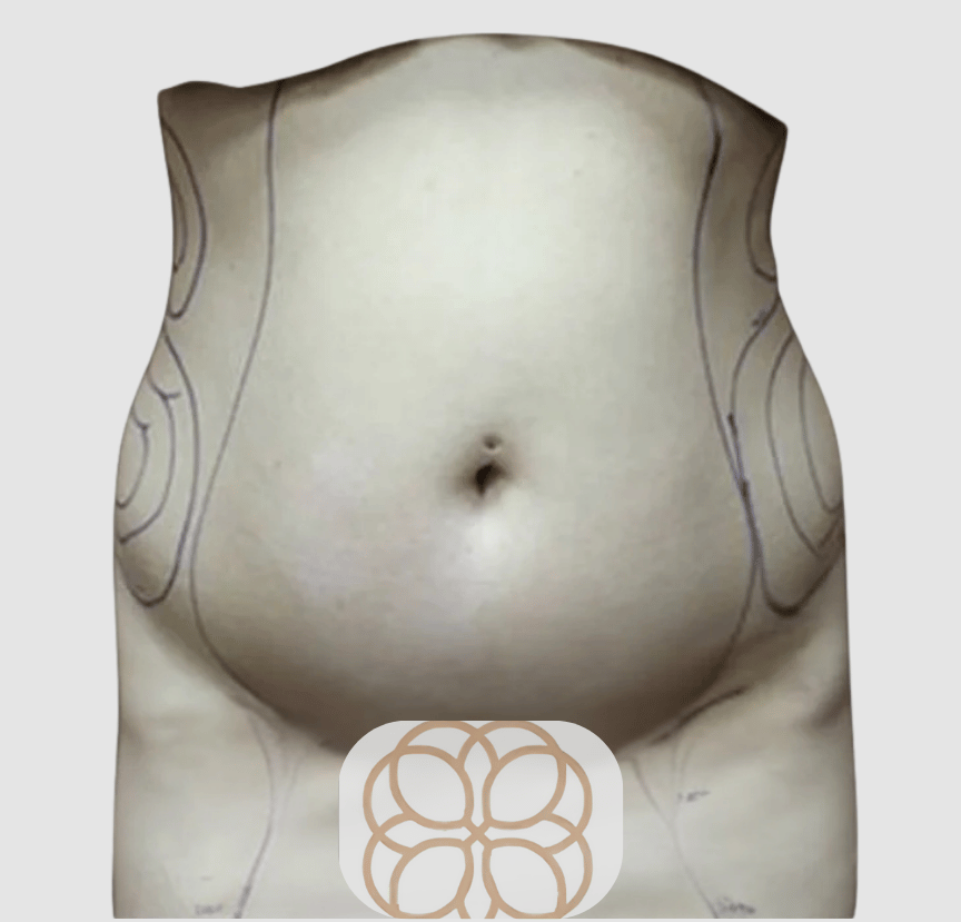 Liposuction before