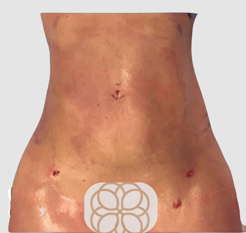 Liposuction after