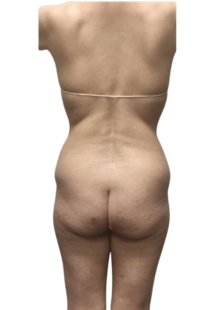 BBL Augmentation before