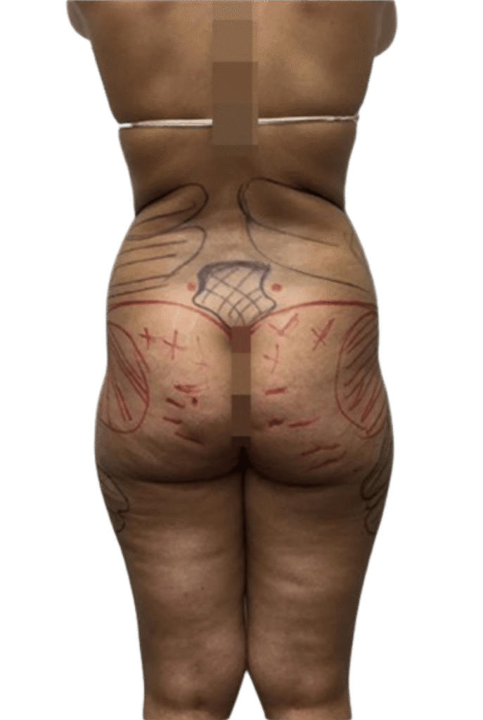 BBL + Liposuction surgery before