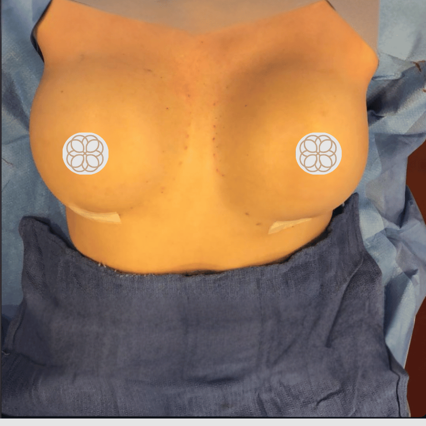 Breast Asymmetry Augmentation after