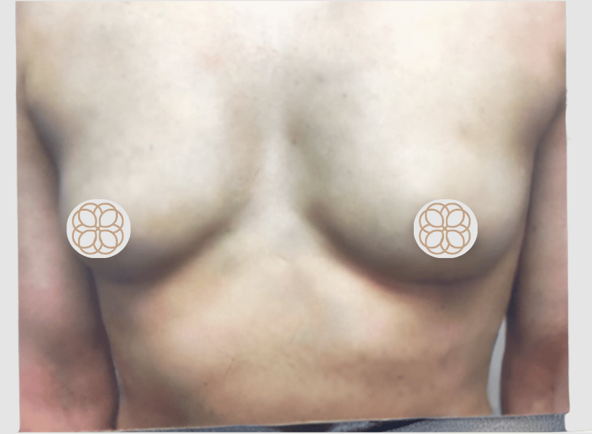 Breast Asymmetry Augmentation before