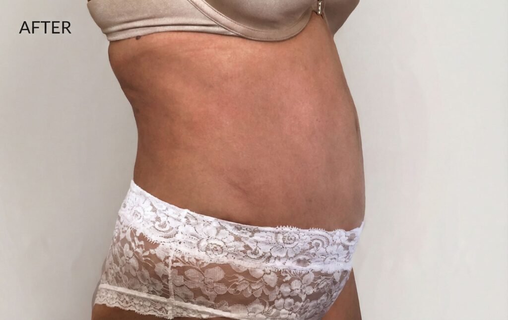 Tummy Tuck & Liposuction after