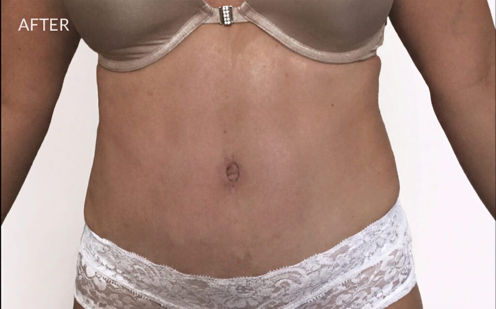 Body Liposuction and Tummy Tuck after