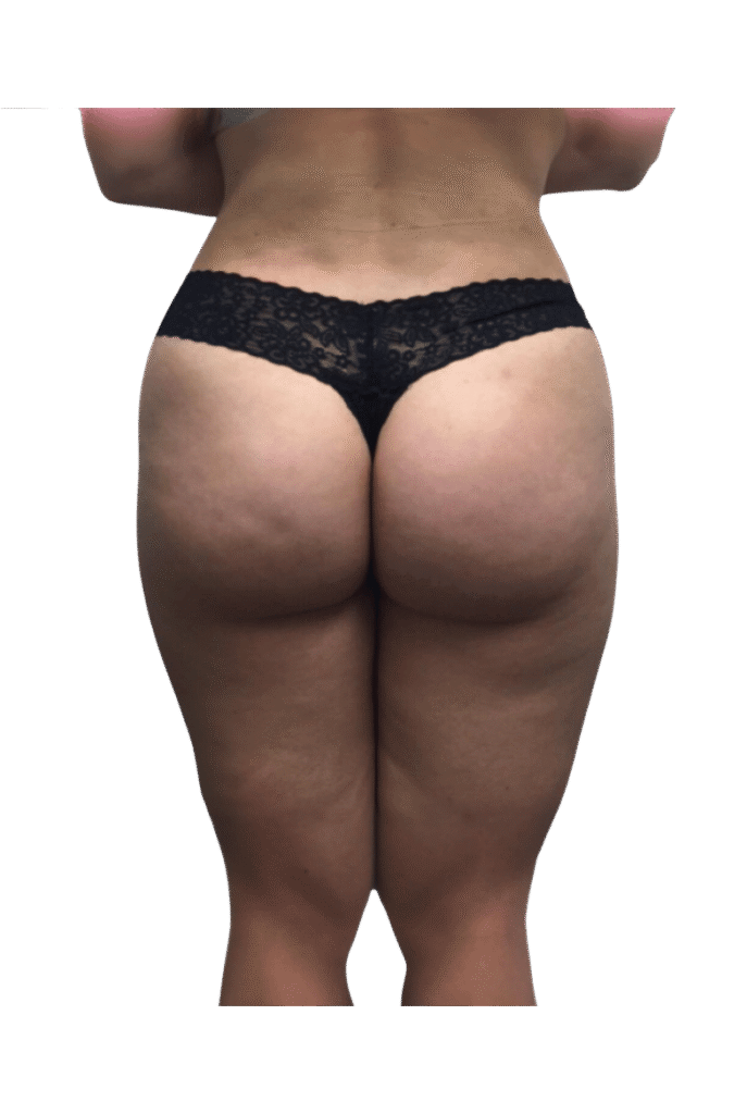 BBL + Liposuction after