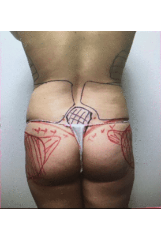 BBL + Liposuction before
