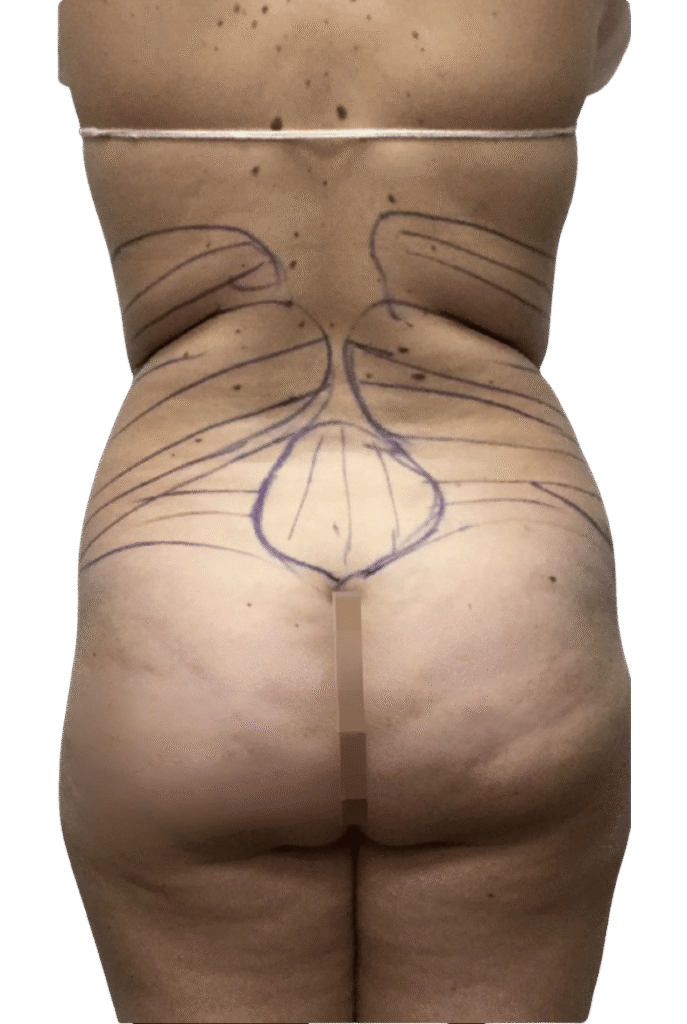 Liposuction before
