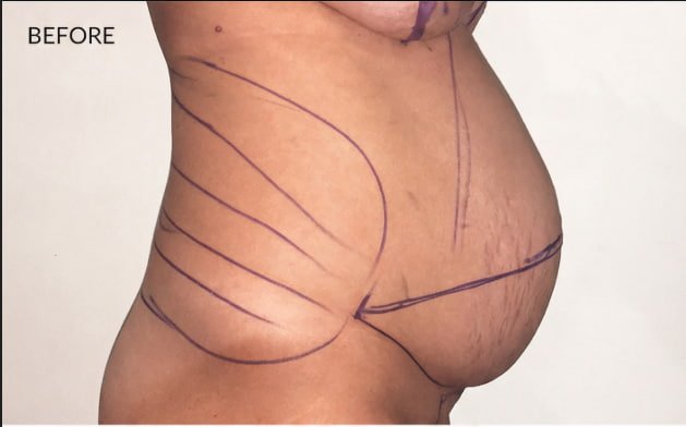 Tummy Tuck & Liposuction before