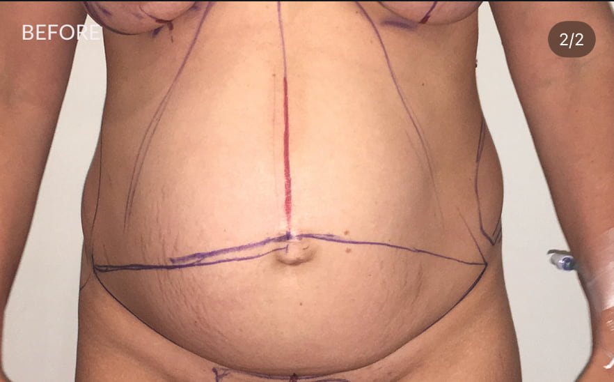 Body Liposuction and Tummy Tuck before