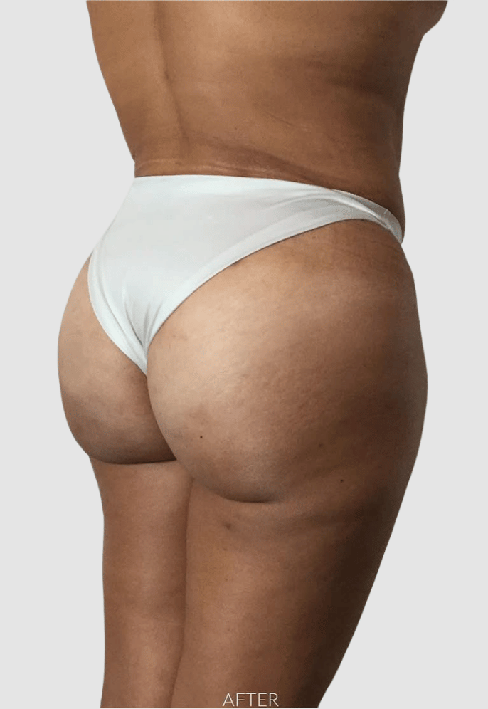tummy tuck + breast lift angle 2 after