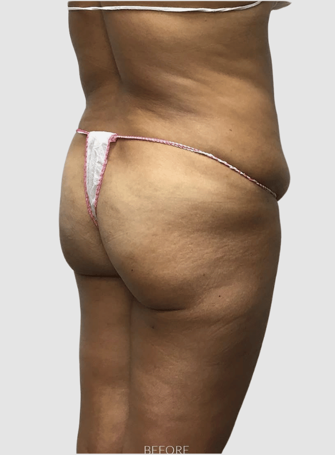 tummy tuck + breast lift angle 2 before