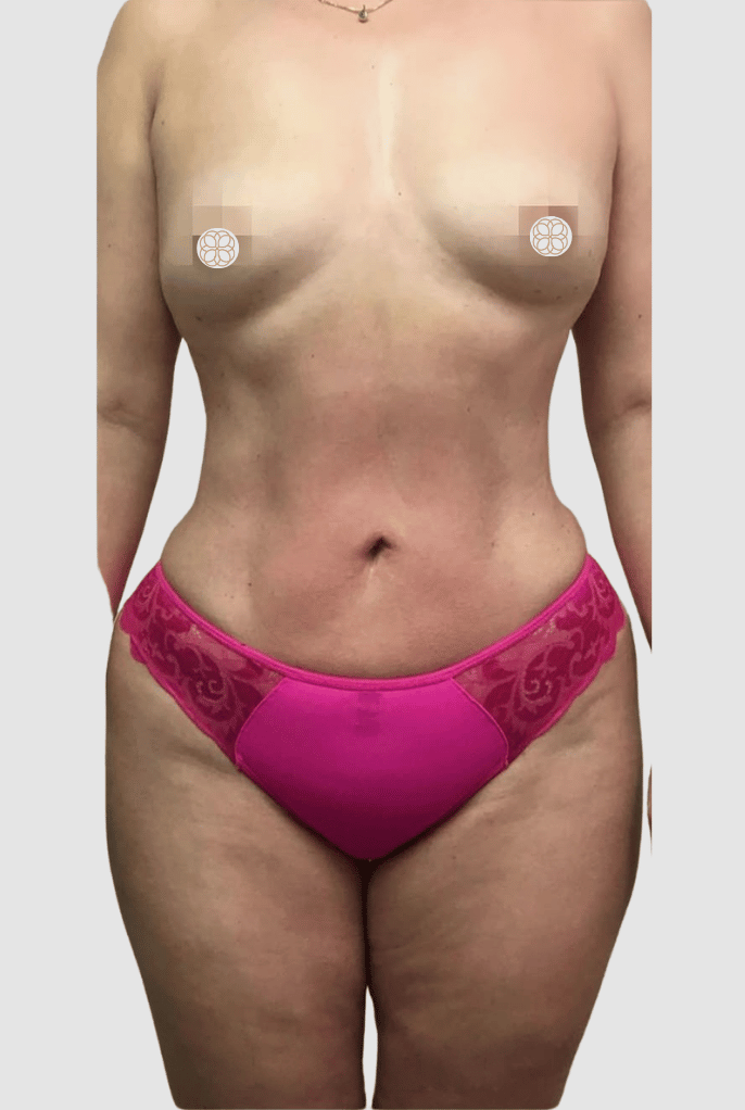 Liposculpting after