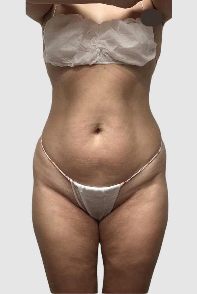 Liposculpting before