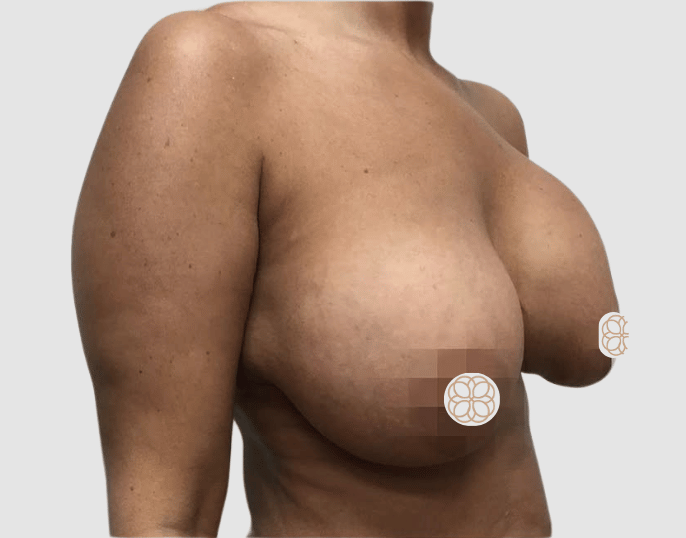 Breast Implant Revision Surgery before