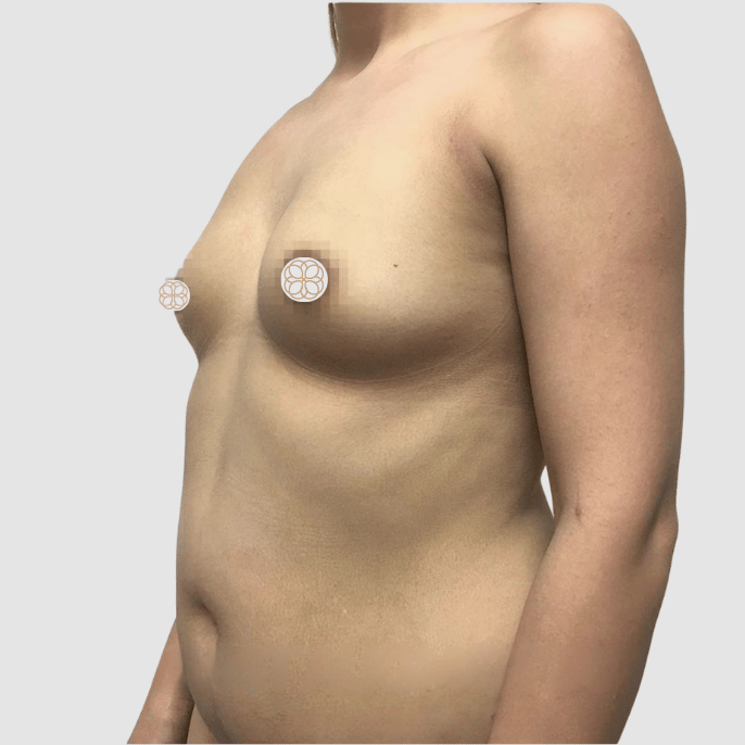 Breast Implant before