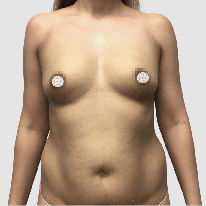 Breast Implant  before