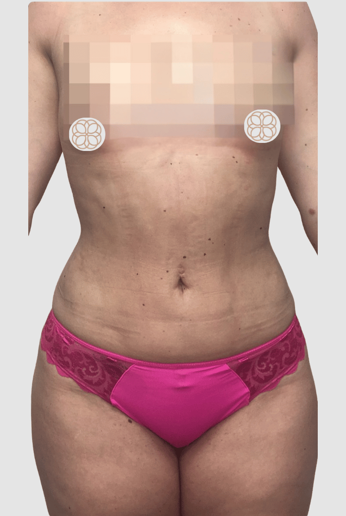 Liposuction Abdomen & Flank  after