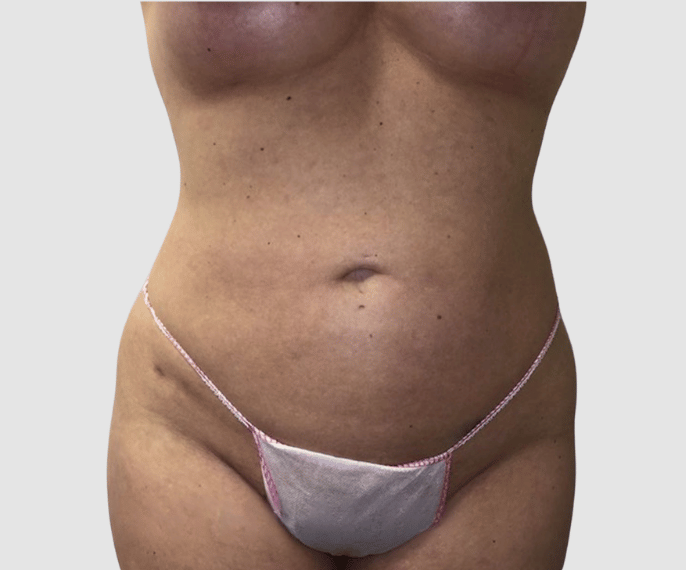 Liposuction Abdomen & Flank  after