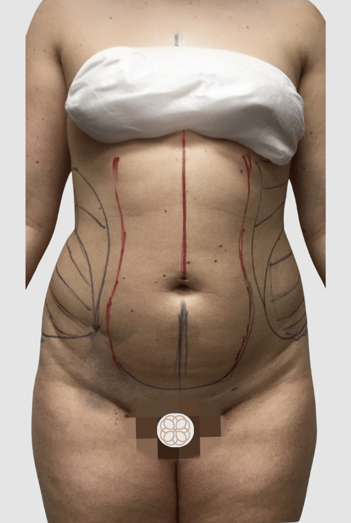 Liposuction Abdomen & Flank  before