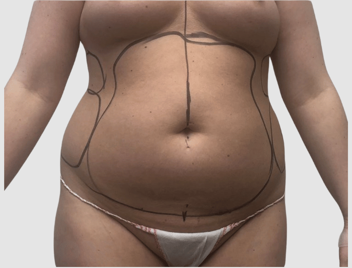 Liposuction Abdomen & Flank  before