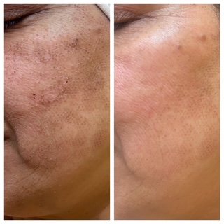 Before skin resurfacing