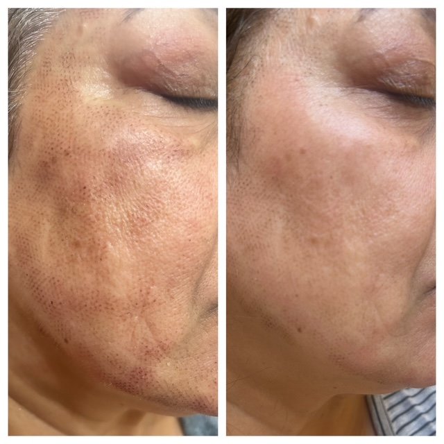 Before skin resurfacing