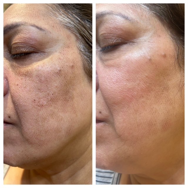 Before skin resurfacing