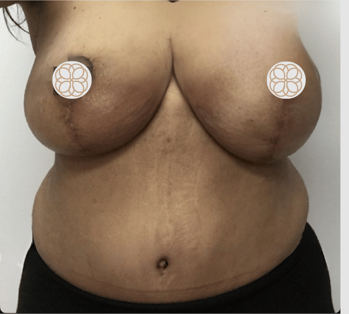 tummy tuck + breast lift after