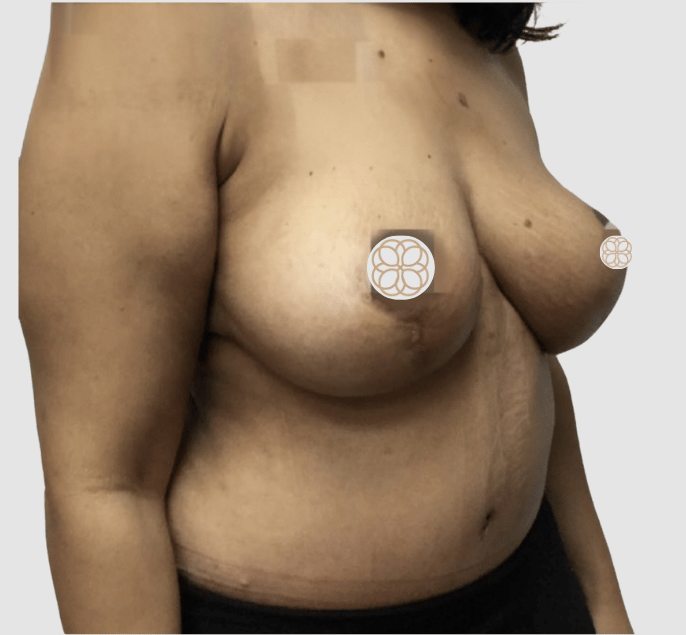 tummy tuck + breast lift angle 2 after