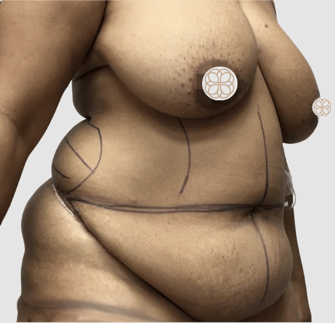tummy tuck + breast lift angle 2 before